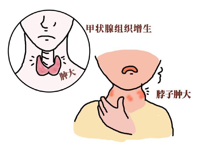 甲状腺结节的症状有哪些表现？中医辨证：警惕这些气血失衡的信号