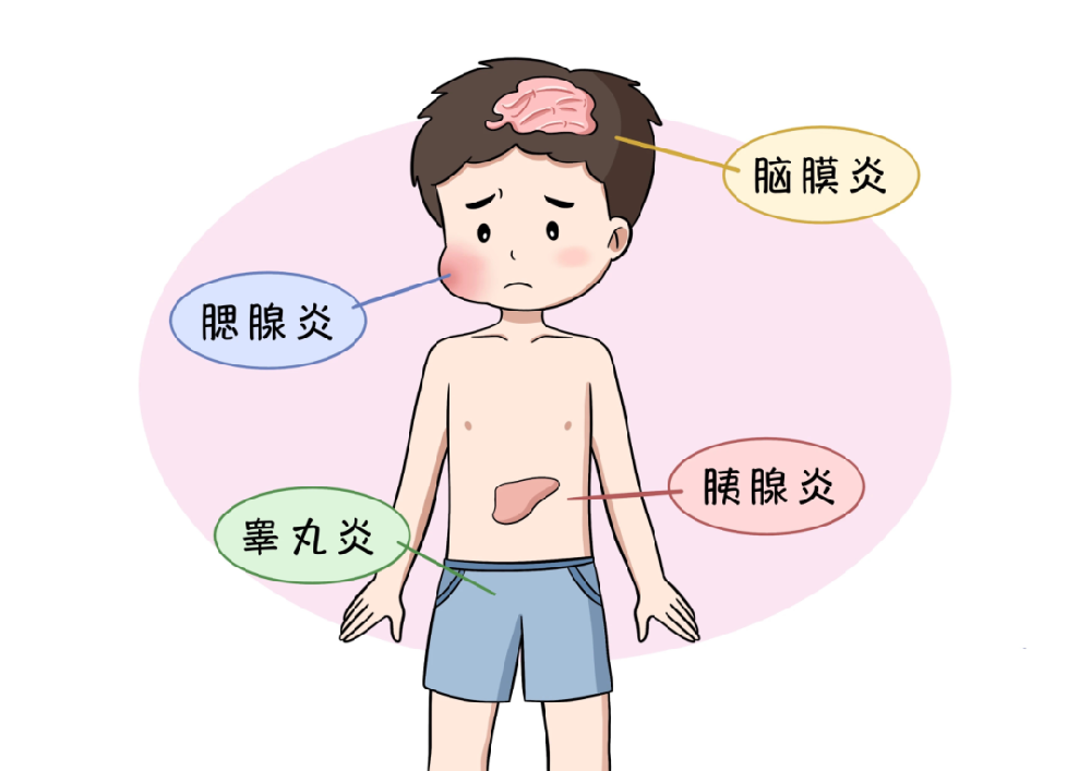 腮腺炎病史会影响生育吗？青春期后患腮腺炎可能并发睾丸炎，是导致无精症的原因之一