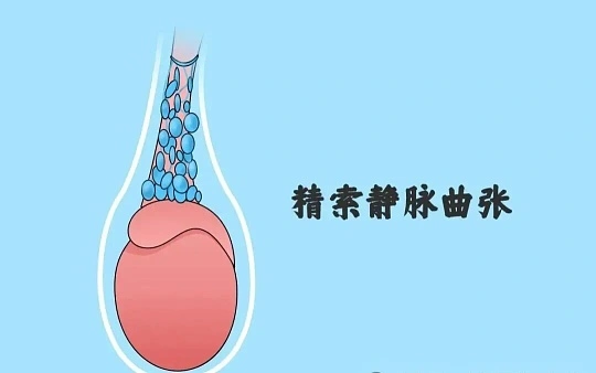 长时间热水浴后阴囊坠胀?高温影响或需关注精索静脉曲张健康