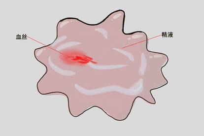 备孕期间精液颜色偏红?多与生殖部位炎症相关