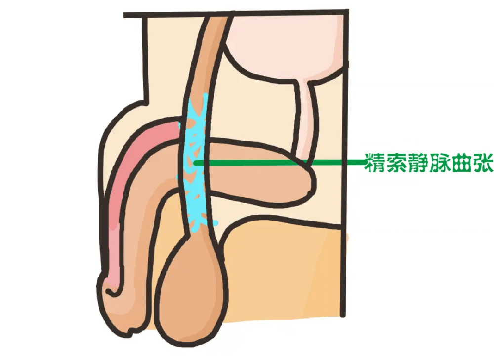 阴囊温度偏高、触感发热？警惕精索静脉曲张问题