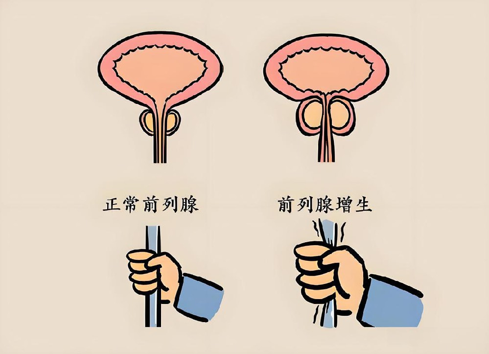 前列腺增生和前列腺炎是一回事吗？二者本质、人群完全不同