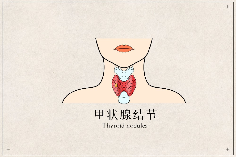 甲状腺结节≠癌症,这些误区要避开!