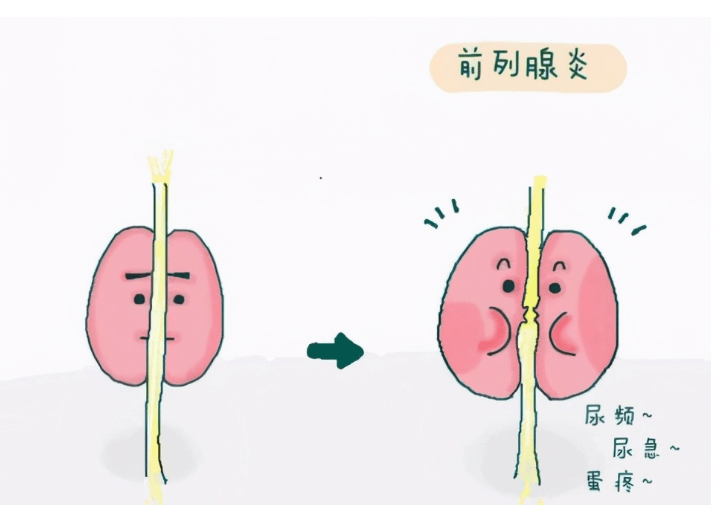 年轻男性前列腺炎会影响生育吗?急性期可能影响精子质量,规范治疗后大多可逆