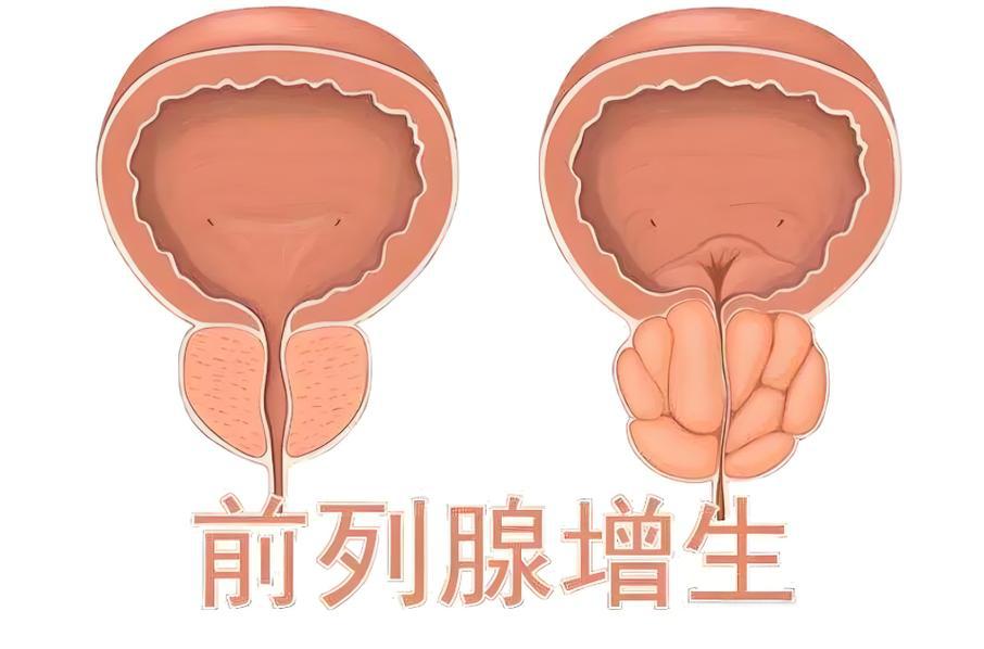 前列腺增生患者能憋尿锻炼吗？刻意憋尿损伤膀胱功能，反而加重排尿困难