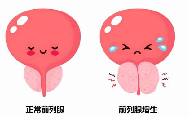 前列腺增生长期不治会怎样？可能引起反复尿路感染、膀胱结石甚至肾积水