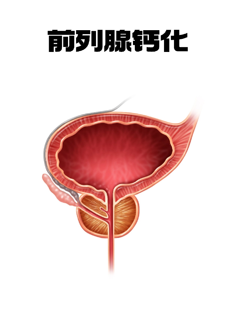 前列腺钙化灶会变成结石吗？长期发展可能形成真性结石，无症状无需处理