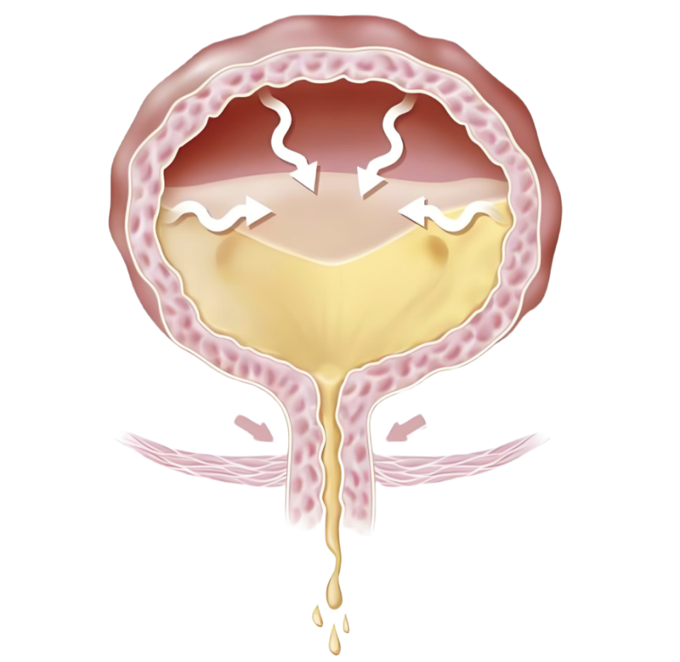 前列腺增生患者如何预防急性尿潴留？避免受凉、饮酒、久坐及服用抗过敏药等诱因
