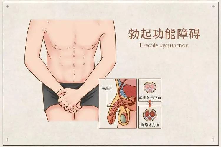 ED 中西医结合治疗怎么搭配？西药快速改善勃起，中药调理全身，两者起效协同
