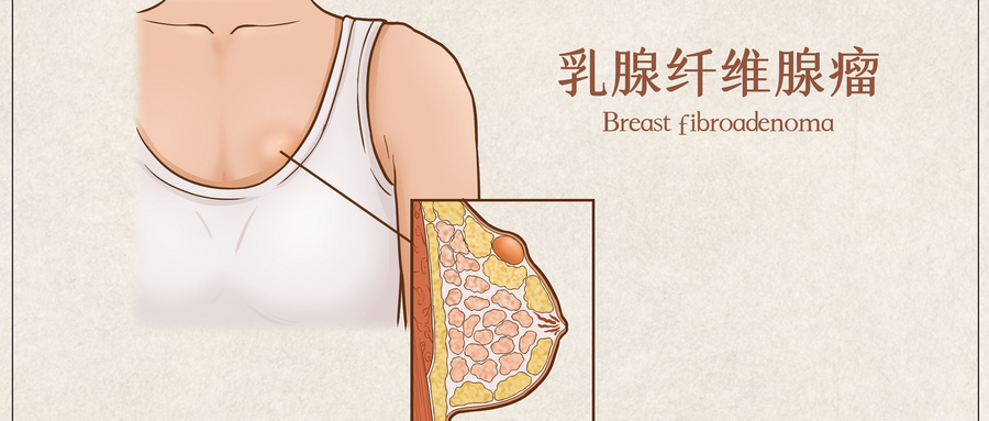乳房胀痛、结节反复?成都经方堂熊杰主任:3 个坏习惯,赶紧改!